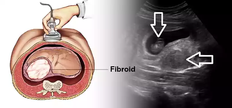 What is Fibroid Ultrasound Pregnancy